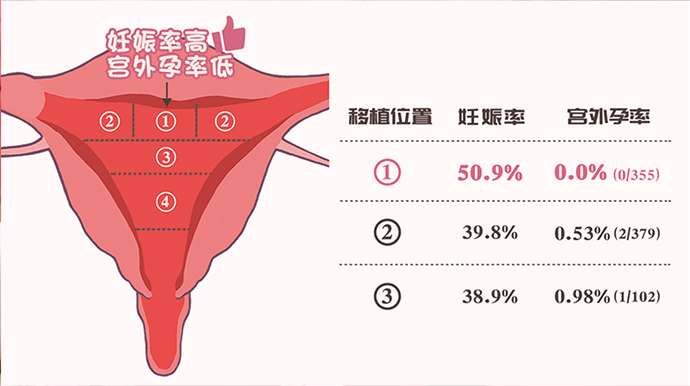 移植位置与妊娠率宫外孕率对比图表 胚胎移植位置与妊娠率及宫外孕率对比数据:合适的位置妊娠率50.9%、宫外孕率0%