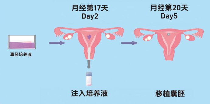SEET移植月经周期时间轴：月经第17天Day2注入培养液，月经第20天Day5移植囊胚